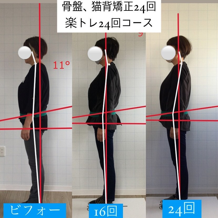 フル矯正楽トレインナー24回コースのビフォーアフター | ブログ | 橋本市の接骨院ならteru接骨院